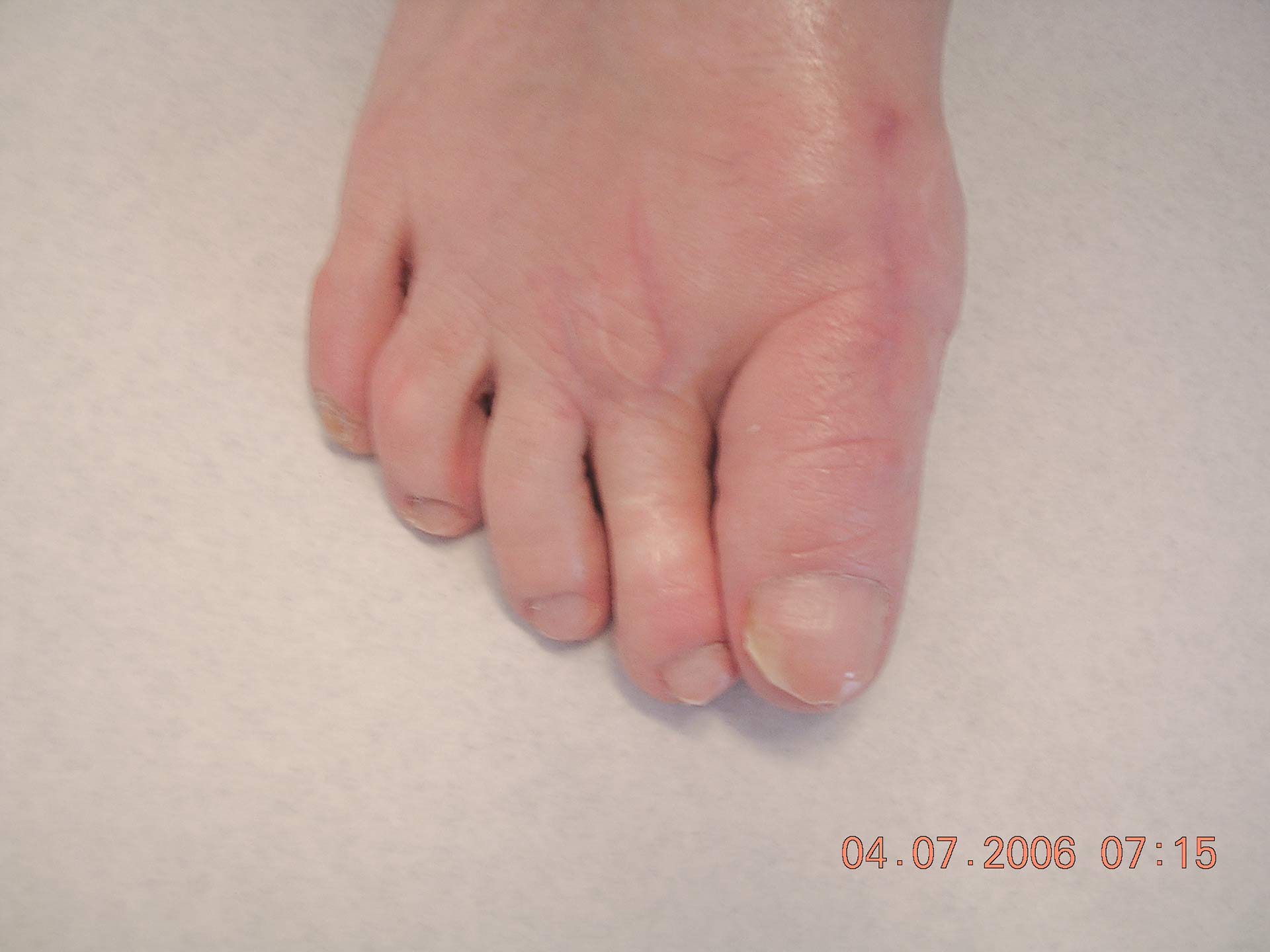Maestro y Alejo Podología | Tratamiento quirúrgico de juanete con dedo por encima de segundo dedo (primer dedo supracutus) | Postoperatorio 1