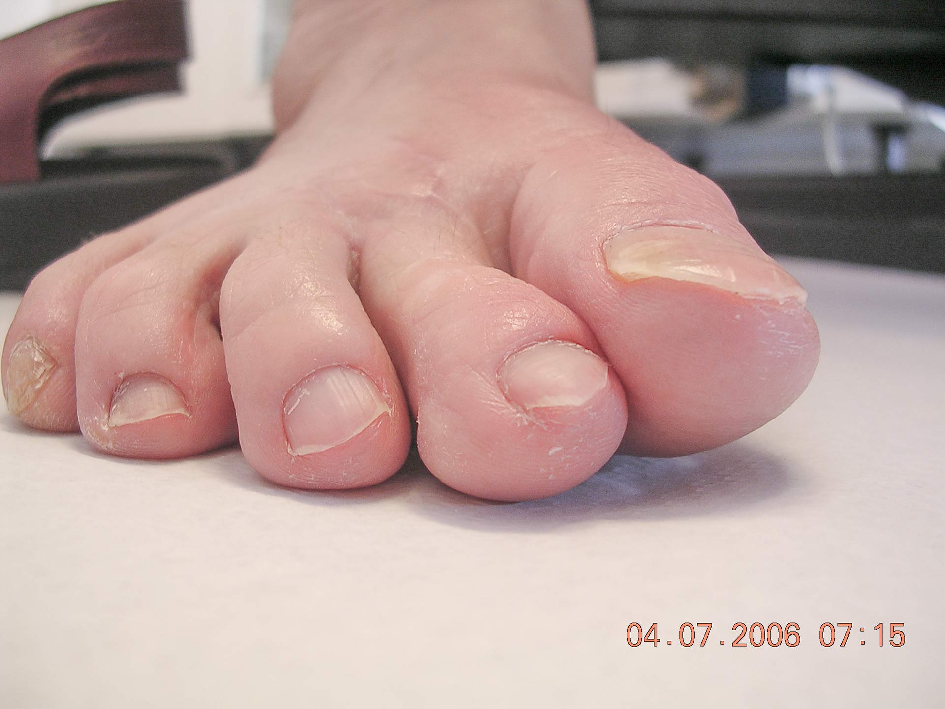 Maestro y Alejo Podología | Tratamiento quirúrgico de juanete con dedo por encima de segundo dedo (primer dedo supracutus) | Postoperatorio 2
