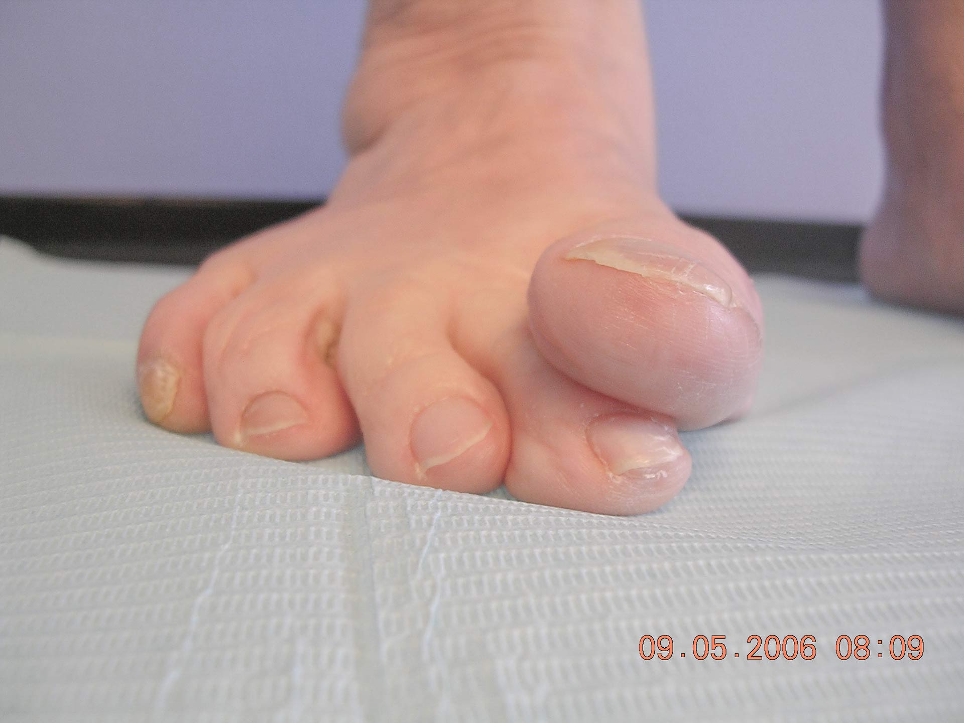 Maestro y Alejo Podología | Tratamiento quirúrgico de juanete con dedo por encima de segundo dedo (primer dedo supracutus) | Preoperatorio 1