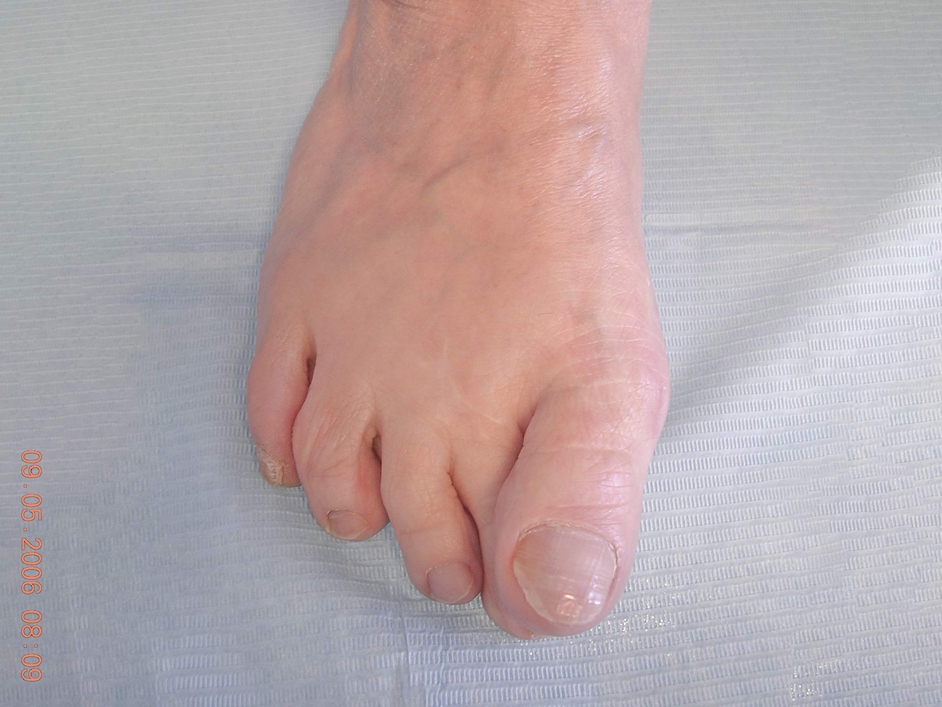 Maestro y Alejo Podología | Tratamiento quirúrgico de juanete con dedo por encima de segundo dedo (primer dedo supracutus) | Preoperatorio 2