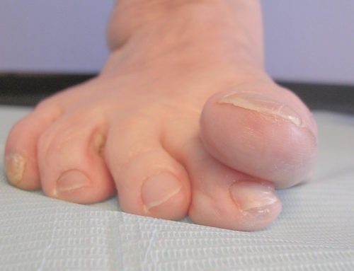 Tratamiento quirúrgico de juanete con dedo por encima de segundo dedo (primer dedo supracutus)