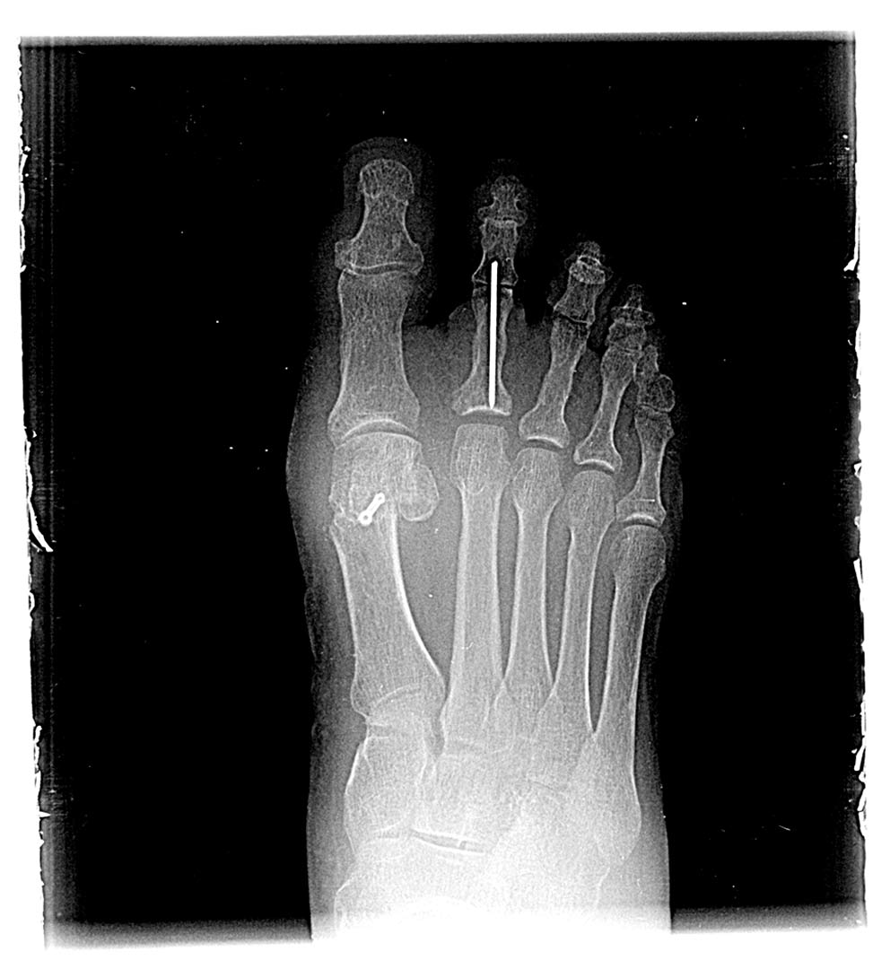 Maestro y Alejo Podología | Tratamiento quirúrgico de Juanetes y segundo dedo en martillo en ambos pies | Postoperatorio Radiografía 2