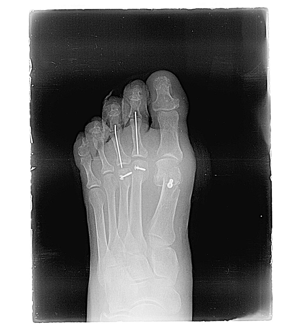 Maestro y Alejo Podología | Tratamiento quirúrgico de Juanetes y segundo dedo en martillo en ambos pies | Postoperatorio Radiografía