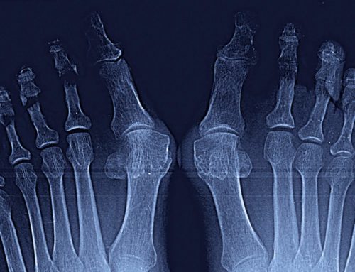 Tratamiento quirúrgico de Juanetes y segundo dedo en martillo en ambos pies