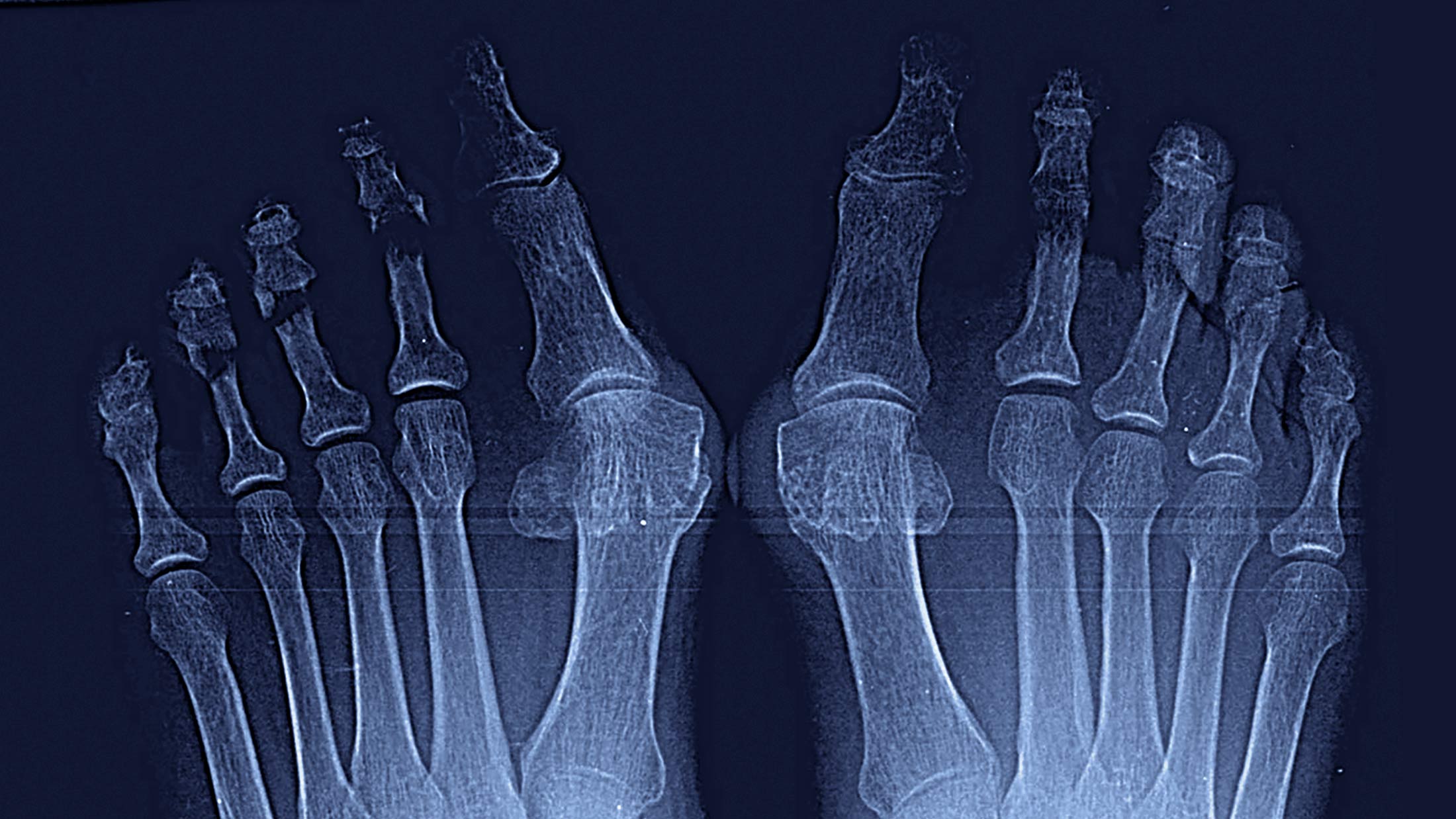 Maestro y Alejo Podología | Tratamiento quirúrgico de Juanetes y segundo dedo en martillo en ambos pies | Preoperatorio Portada