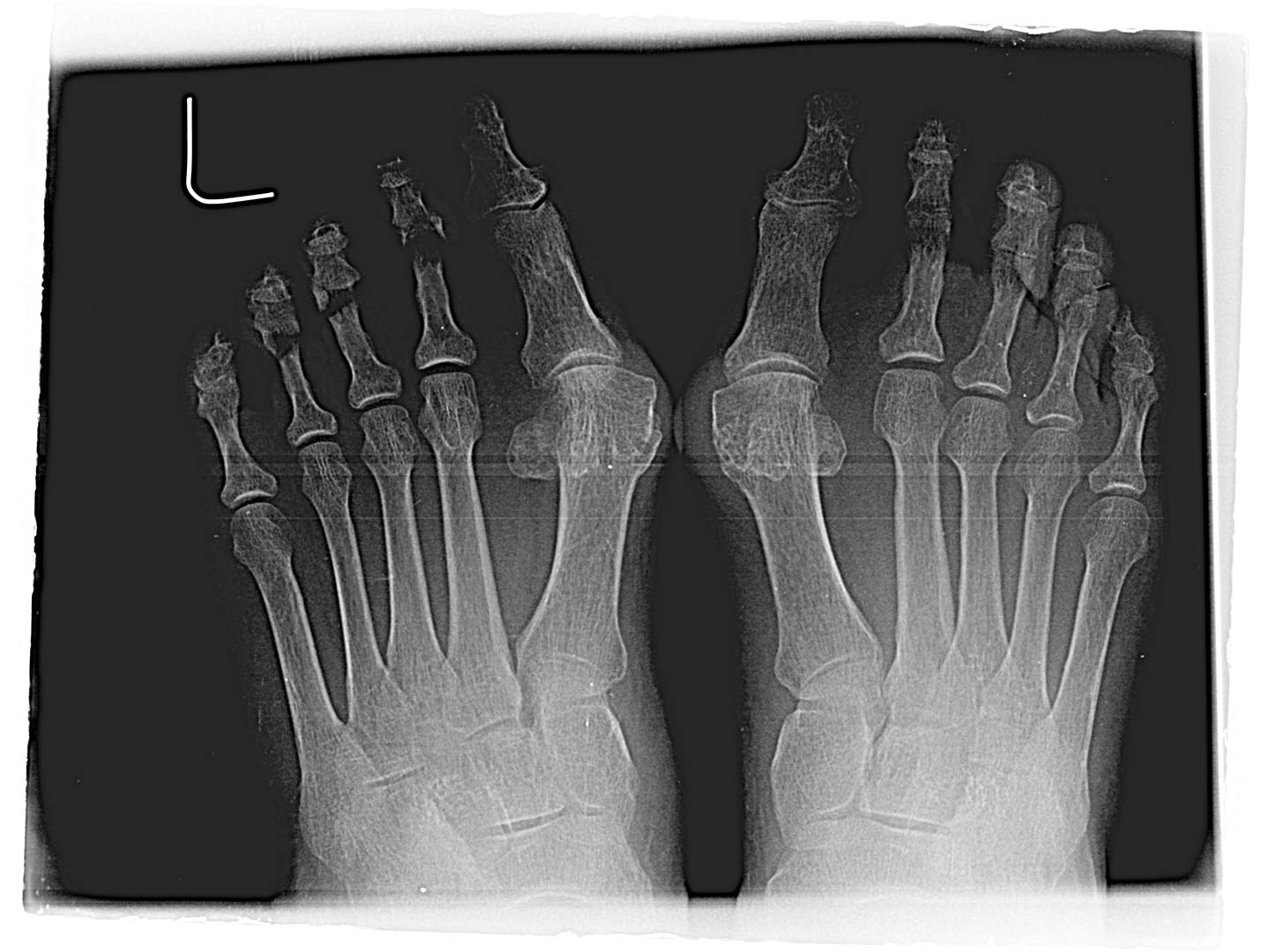 Maestro y Alejo Podología | Tratamiento quirúrgico de Juanetes y segundo dedo en martillo en ambos pies | Preoperatorio Radiografía 1