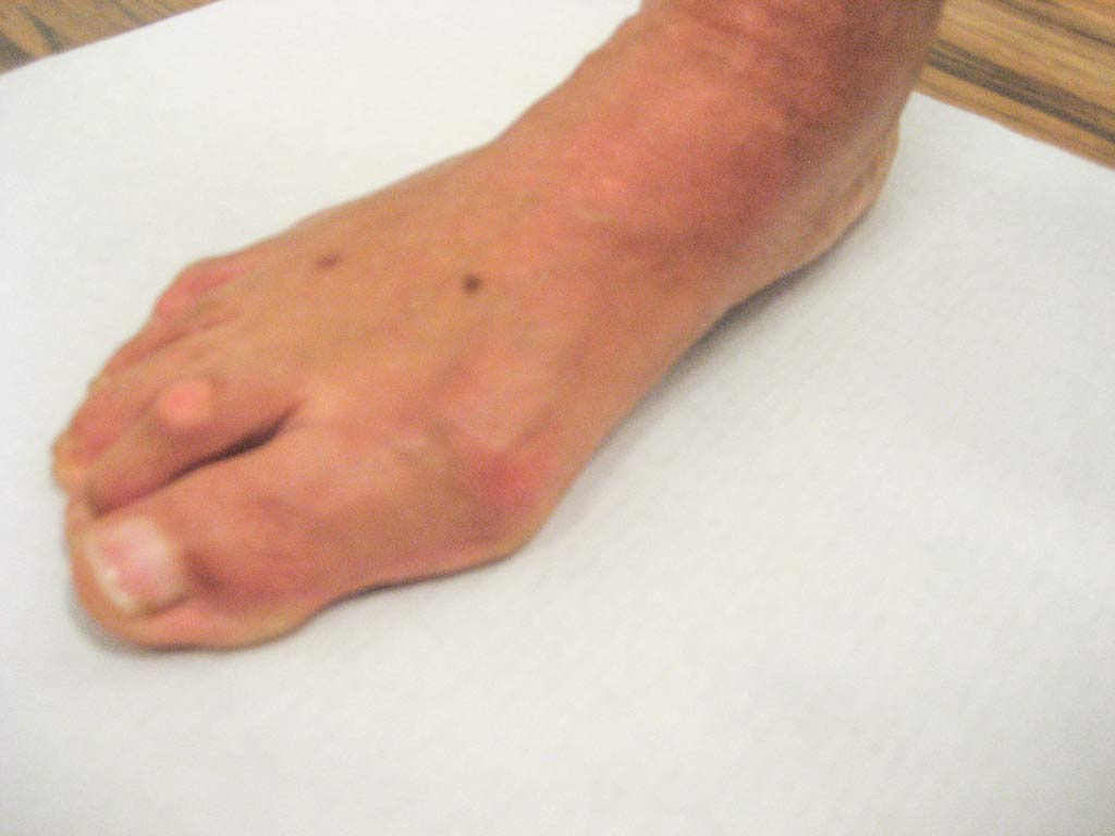 Maestro y Alejo Podología | Tratamiento quirúrgico de Juanetes y segundo dedo en martillo en ambos pies | Preoperatorio 2