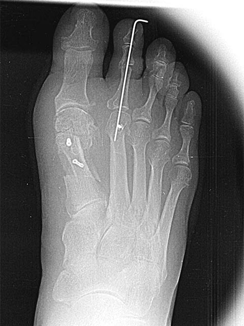 Maestro y Alejo Podología | Tratamiento quirúrgico de Juanete y segundo dedo en martillo cruzado sobre el primero (dedo crossover) | Postoperatorio Radiografía