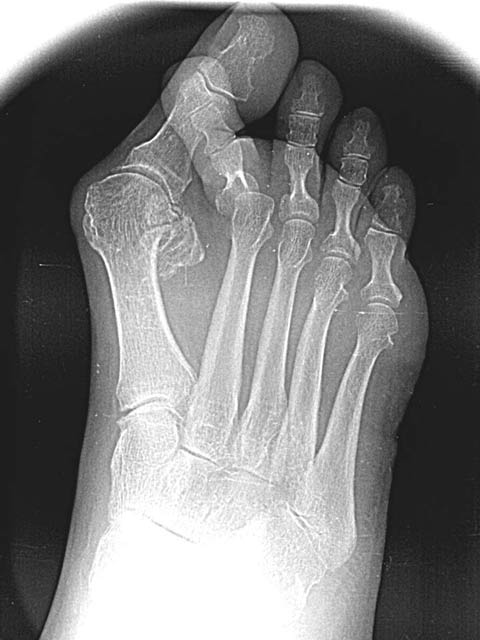 Maestro y Alejo Podología | Tratamiento quirúrgico de Juanete y segundo dedo en martillo cruzado sobre el primero (dedo crossover) | Preoperatorio Radiografía