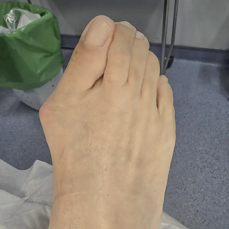 Fotografía de deformidad en el pie: Juanete (Hallux Valgus).