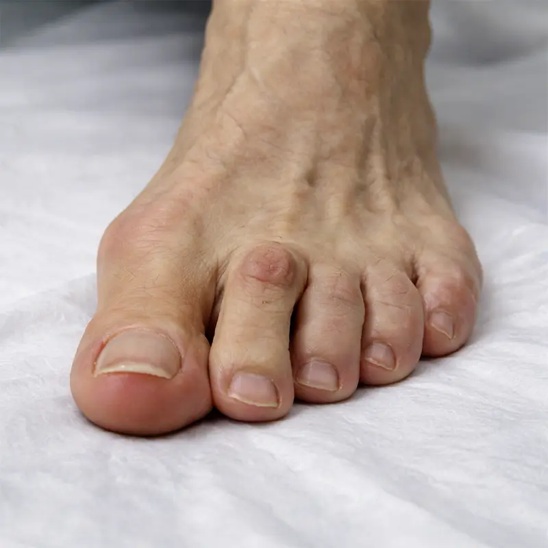 Juanete y segundo dedo en martillo.