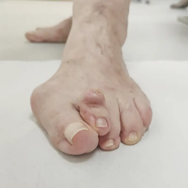 Juanete y segundo dedo en martillo.