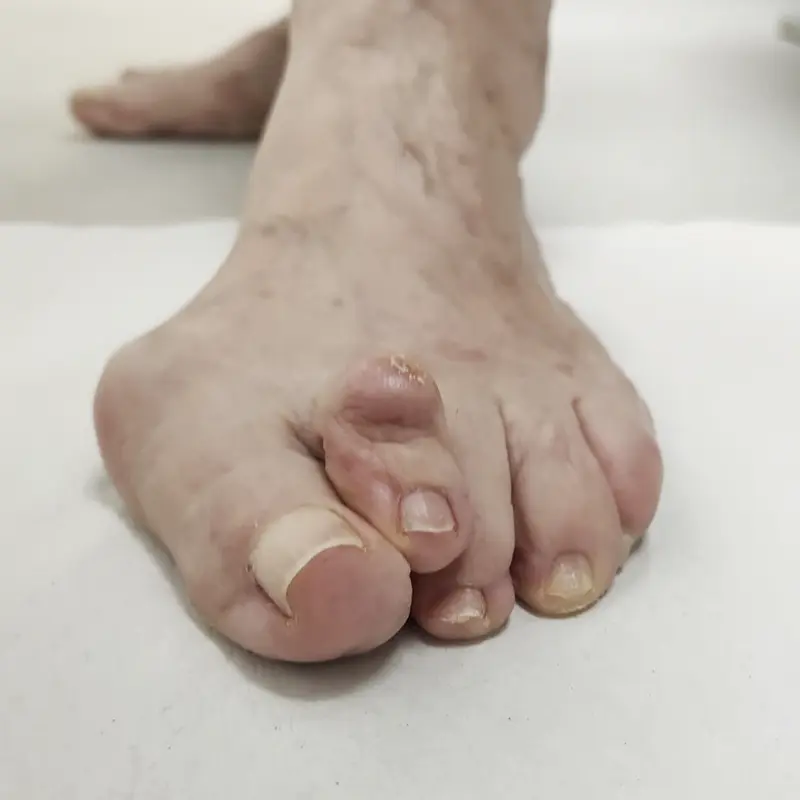 Juanete y segundo dedo en martillo.