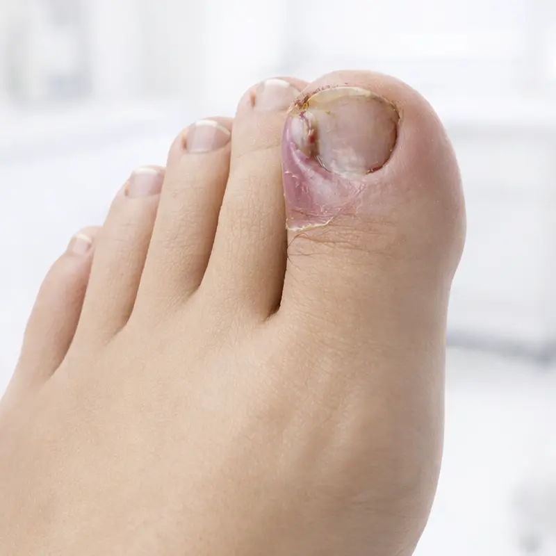 Uña encarnada (onicocriptosis).