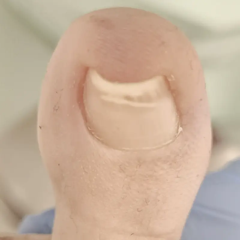 Uña encarnada (onicocriptosis).