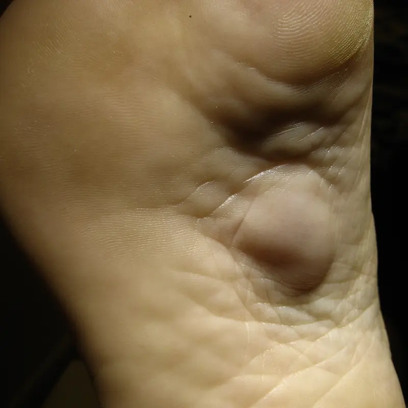 Quiste plantar, lipoma.