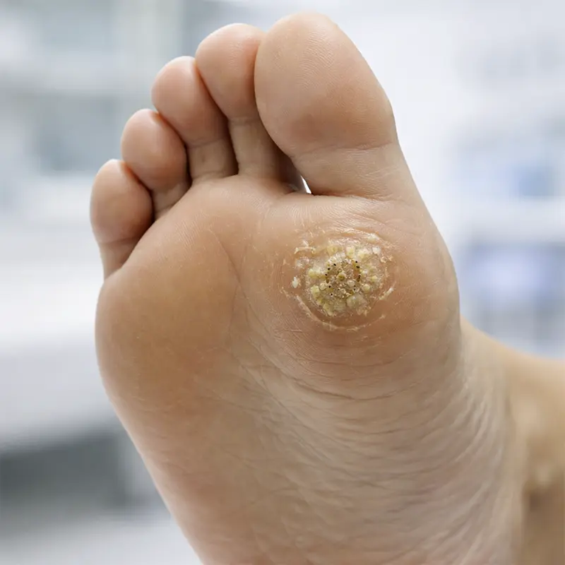 Papiloma o verruga plantar.