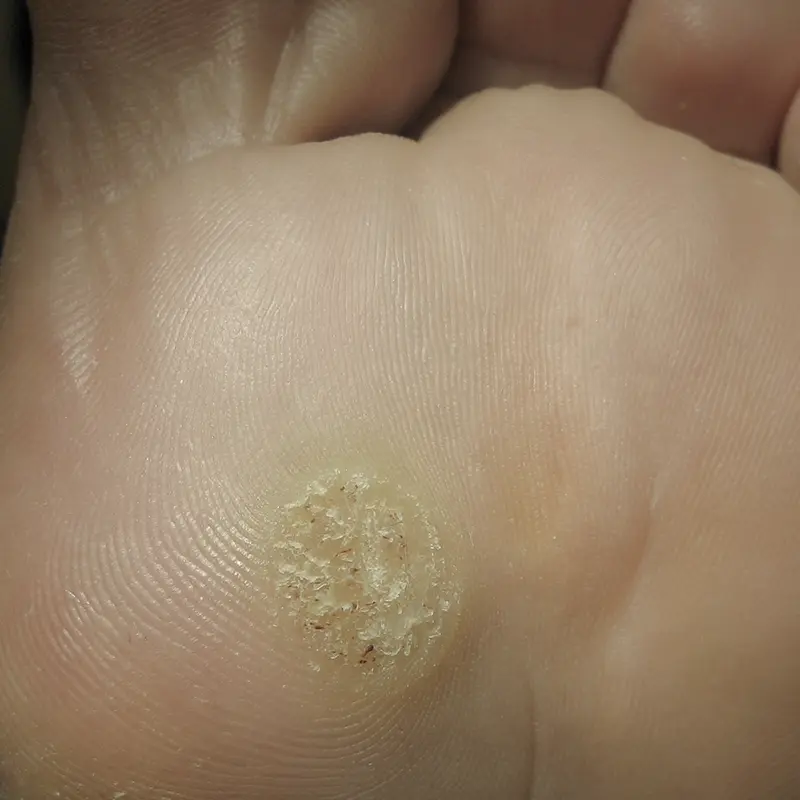 Papiloma o verruga plantar.
