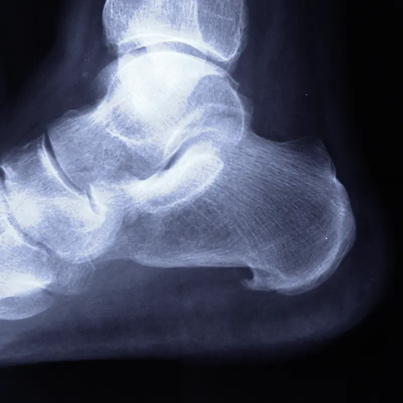 Espolón calcáneo, fascitis plantar, radiografía.