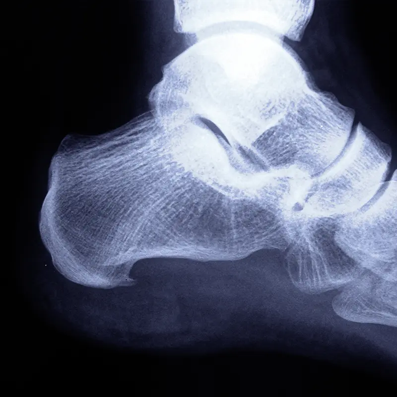 Espolón calcáneo, fascitis plantar, radiografía.