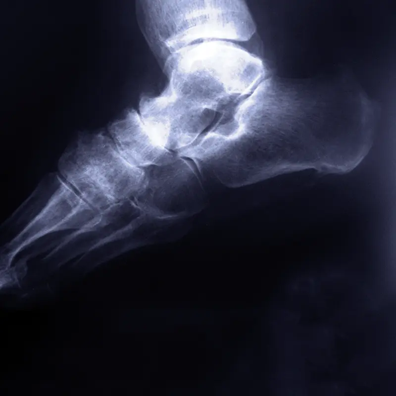 Artrosis mediotarsiana, radiografía.